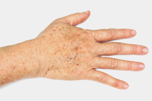 Hvordan bli kvitt aldersflekker på hendene