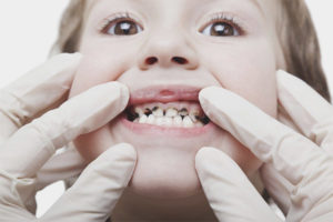 Svart plakett på tennene til et barn
