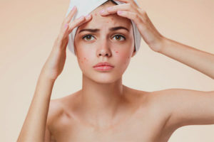 L’acne al front en les dones