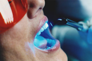 Лазерно избелване на зъбите